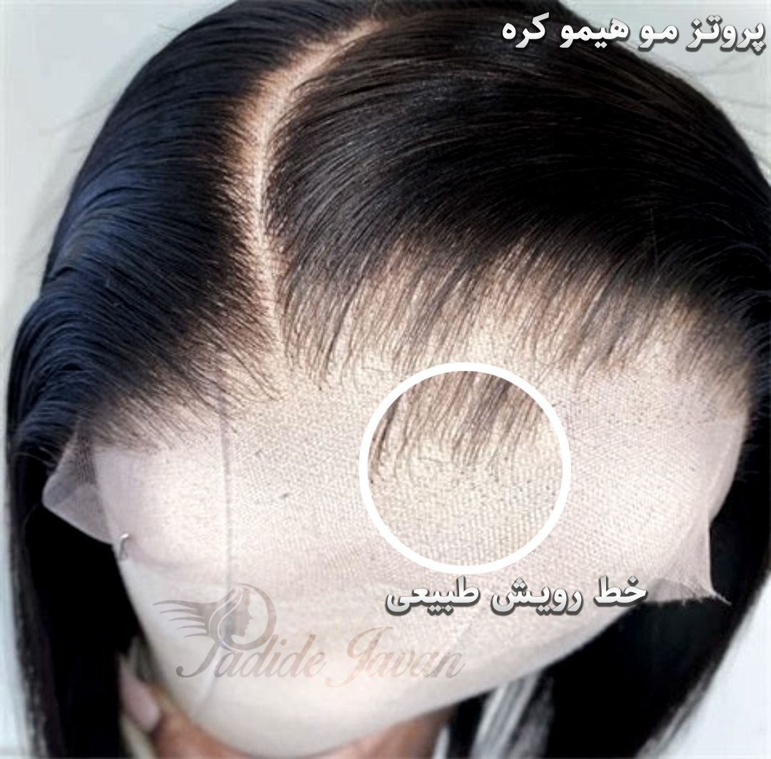 پروتز مو هیمو کره