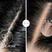 تفاوت پروتز مو ایرانی و خارجی