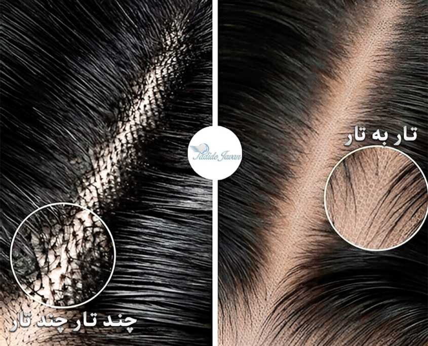 تفاوت پروتز مو ایرانی و خارجی