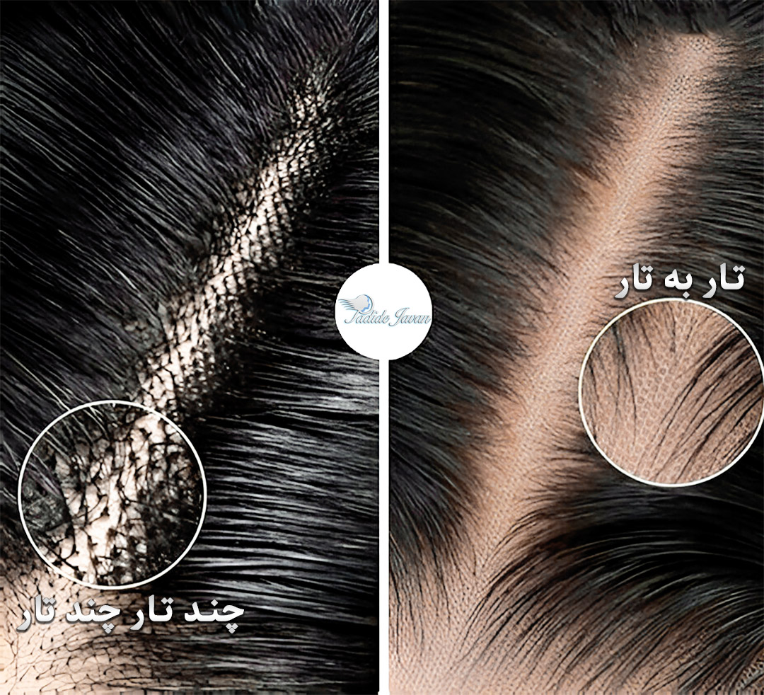 تفاوت پروتز مو ایرانی و خارجی