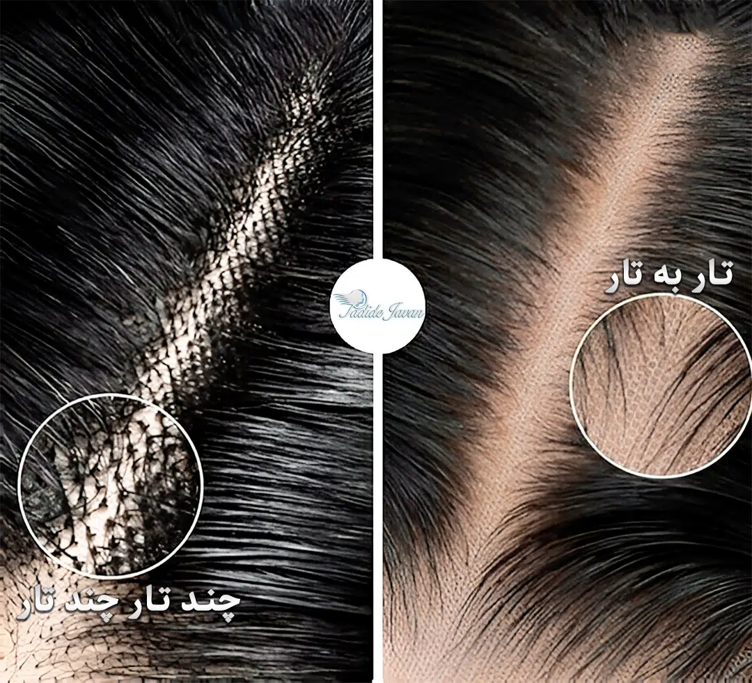 تفاوت پروتز مو ایرانی و خارجی