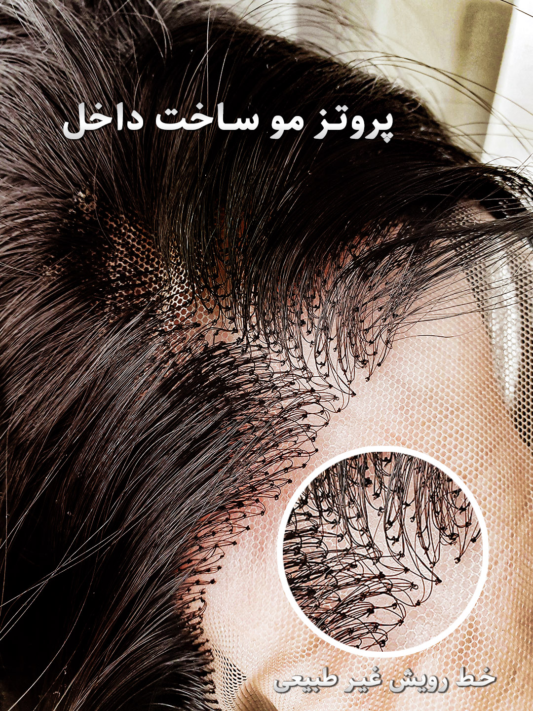 پروتز مو ایرانی