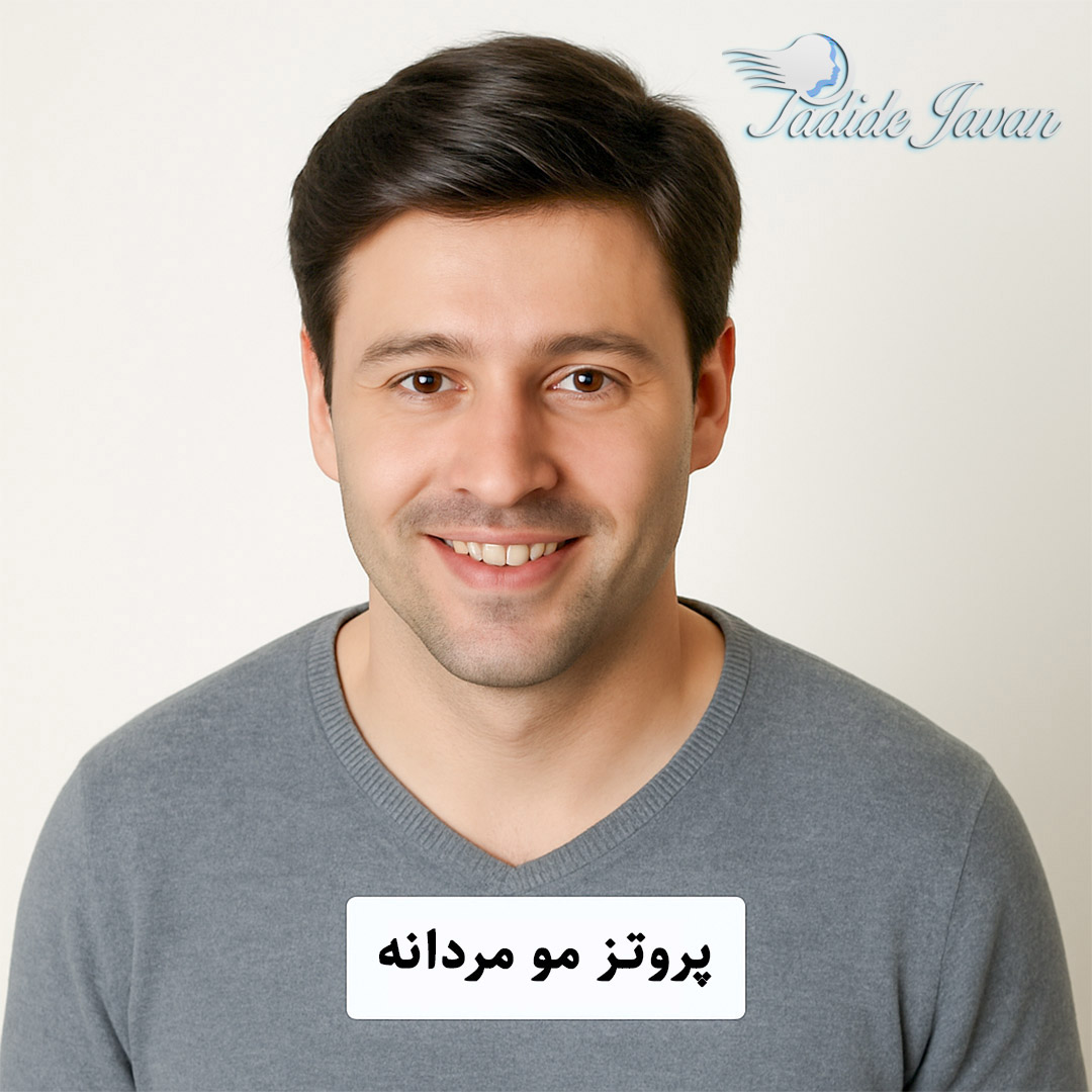 پروتز مو مردانه