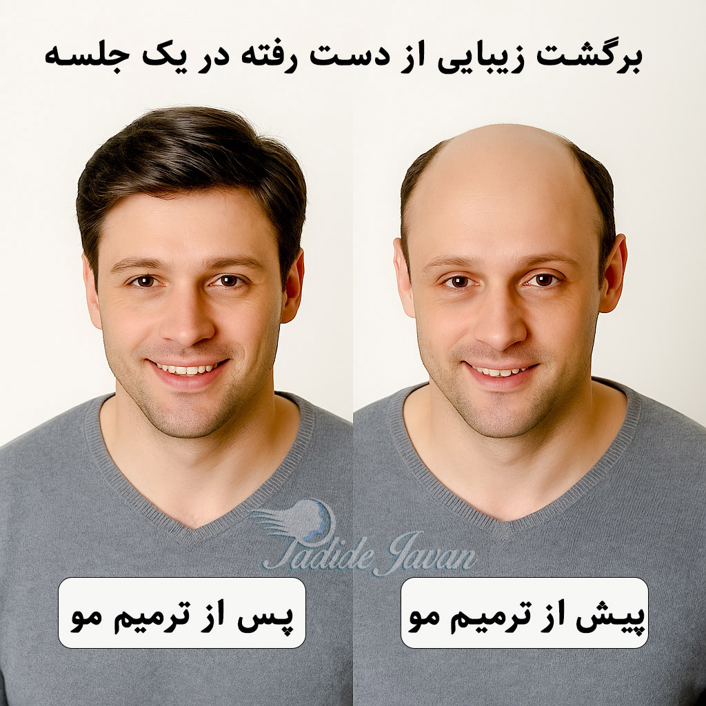 قبل و بعد از پروتز مو مردانه