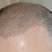 انواع روش های کاشت مو