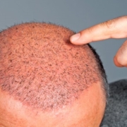 آیا جراحی و کاشت مو توصیه می شوند؟